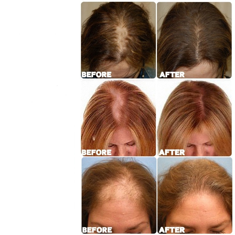 TRSTAY Hair Growth Spray Ginger Hair Grow Hair Essential Oil Treatment Preventing Hair Loss Spray Hair-restorer